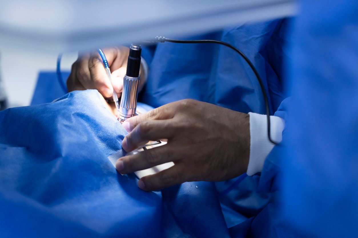 3 méthodes efficaces pour corriger la myopie 2 lasik